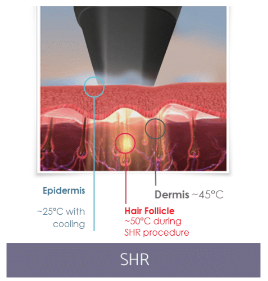 laser hair removal ct