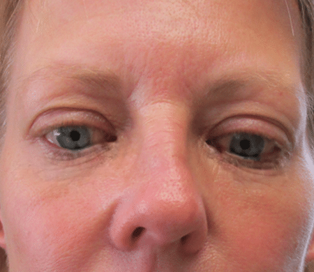 Dermal fillers before & after Hartford Connecticut