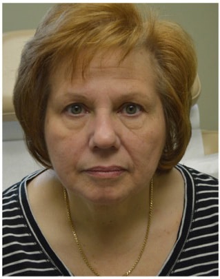 Botox BEFORE & after Hartford
