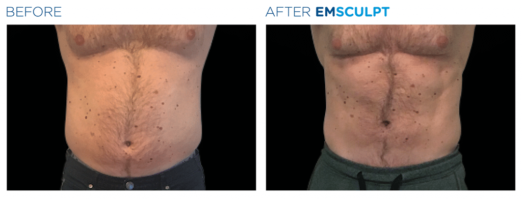 emsculpt before after male abdomen