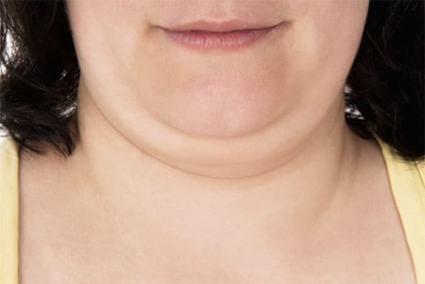 Double Chin treatment Hartford, CT