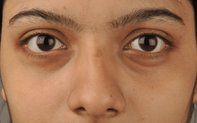 Those Dark Circles Under Your Eyes
