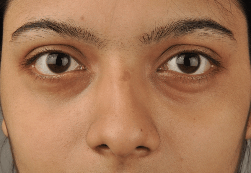 Those Dark Circles Under Your Eyes