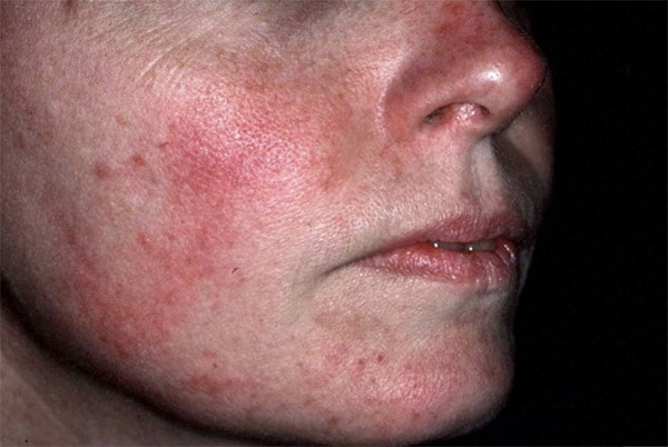 rosacea skin treatment Connecticut