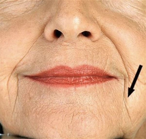 wrinkle treatments in Hartford