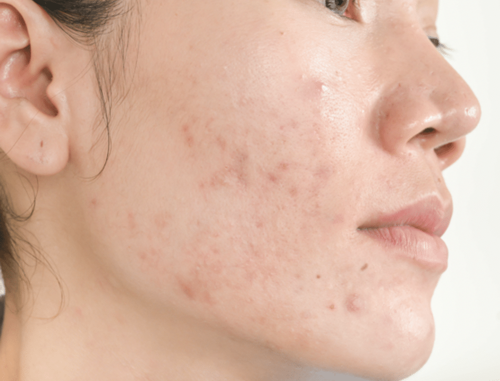  Acne Scar removal treatment Bloomfield, Connecticut