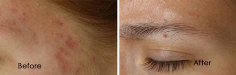 Micro needling Before & Afters
