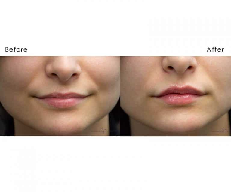 Juvederm (1 Syringe) Vivesse Med Spa Hartford, CT
