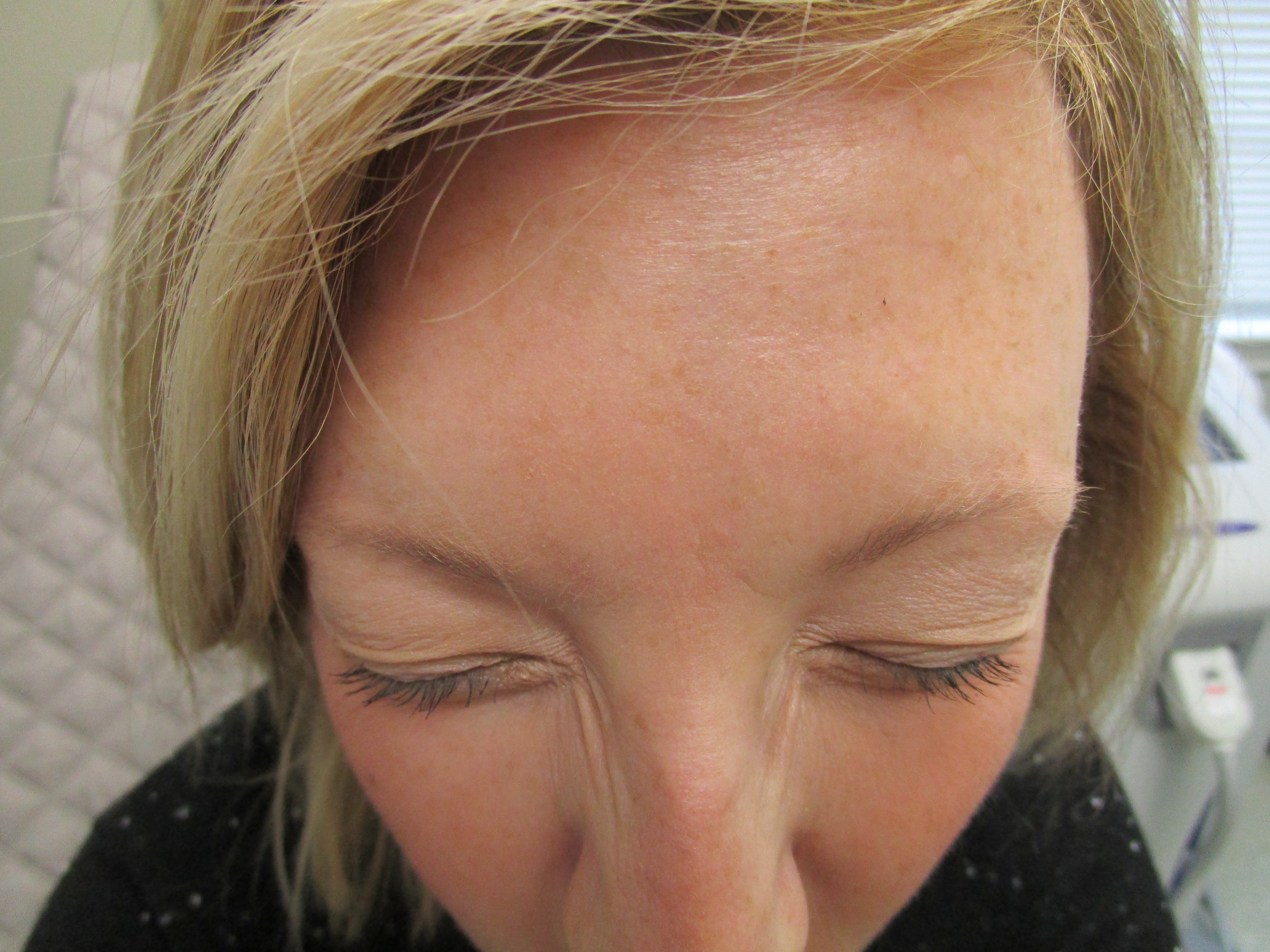 afterglabella2