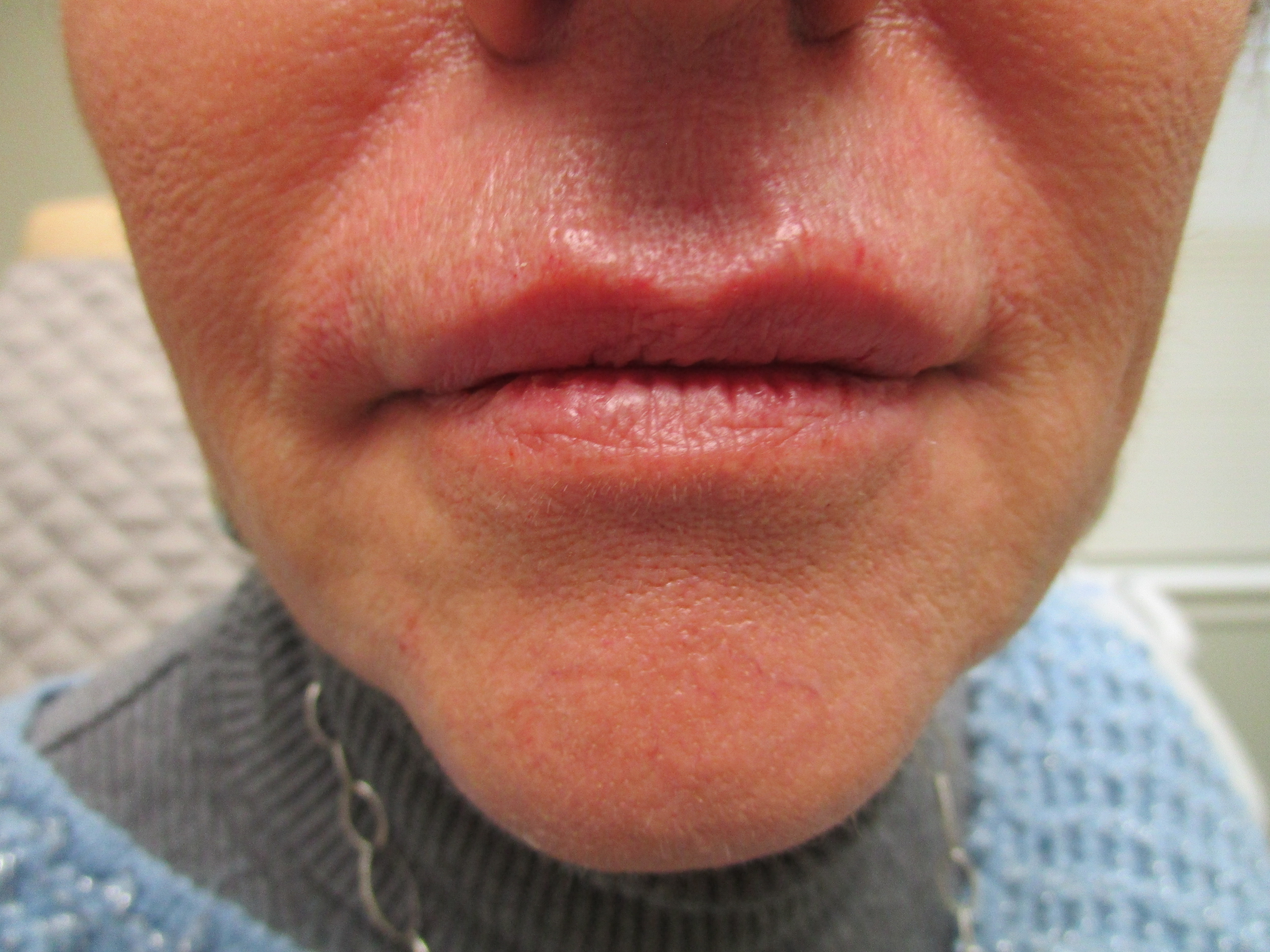 afterlipssmokerslinesVOLBELLA