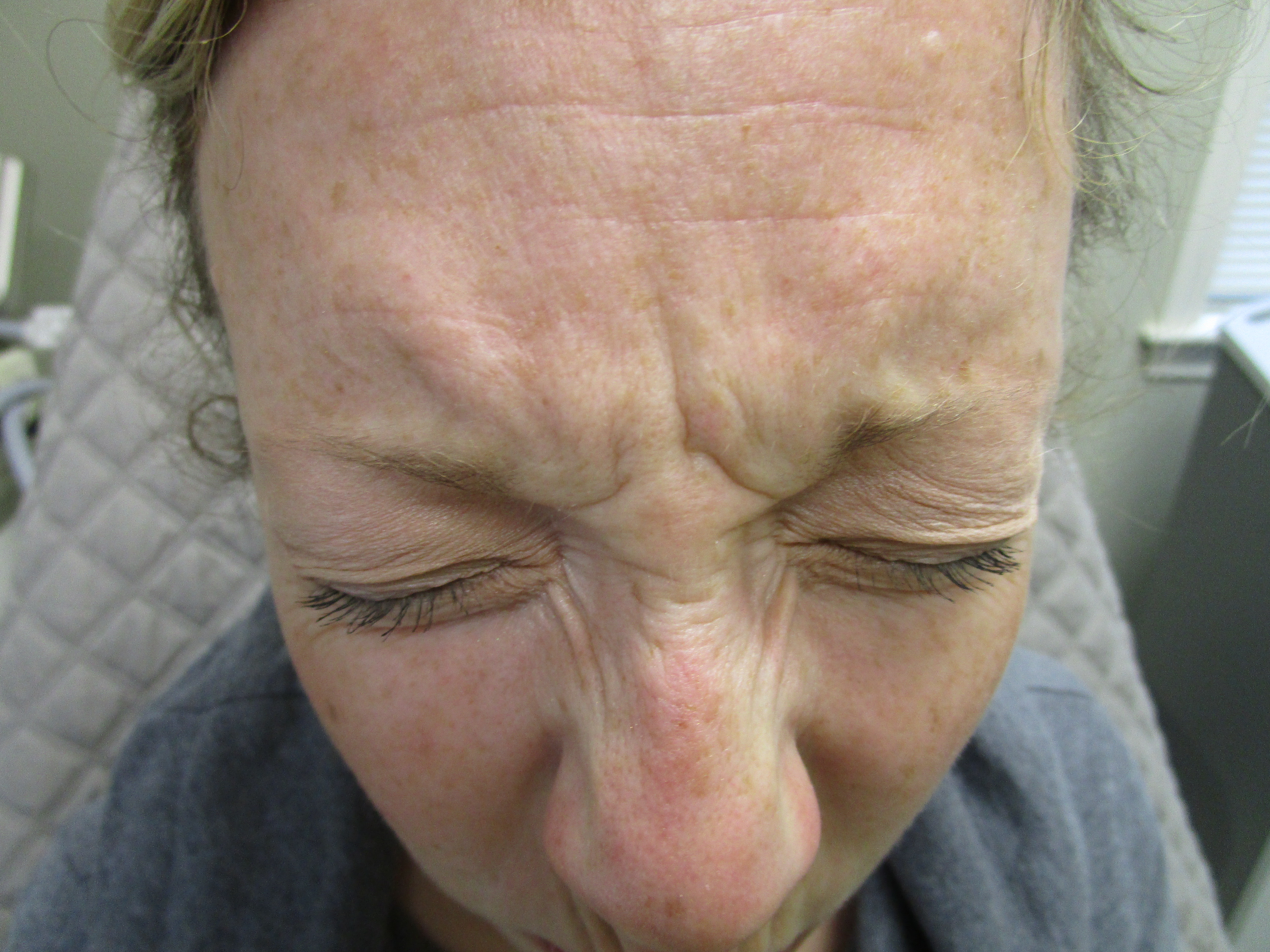 beforeglabella2