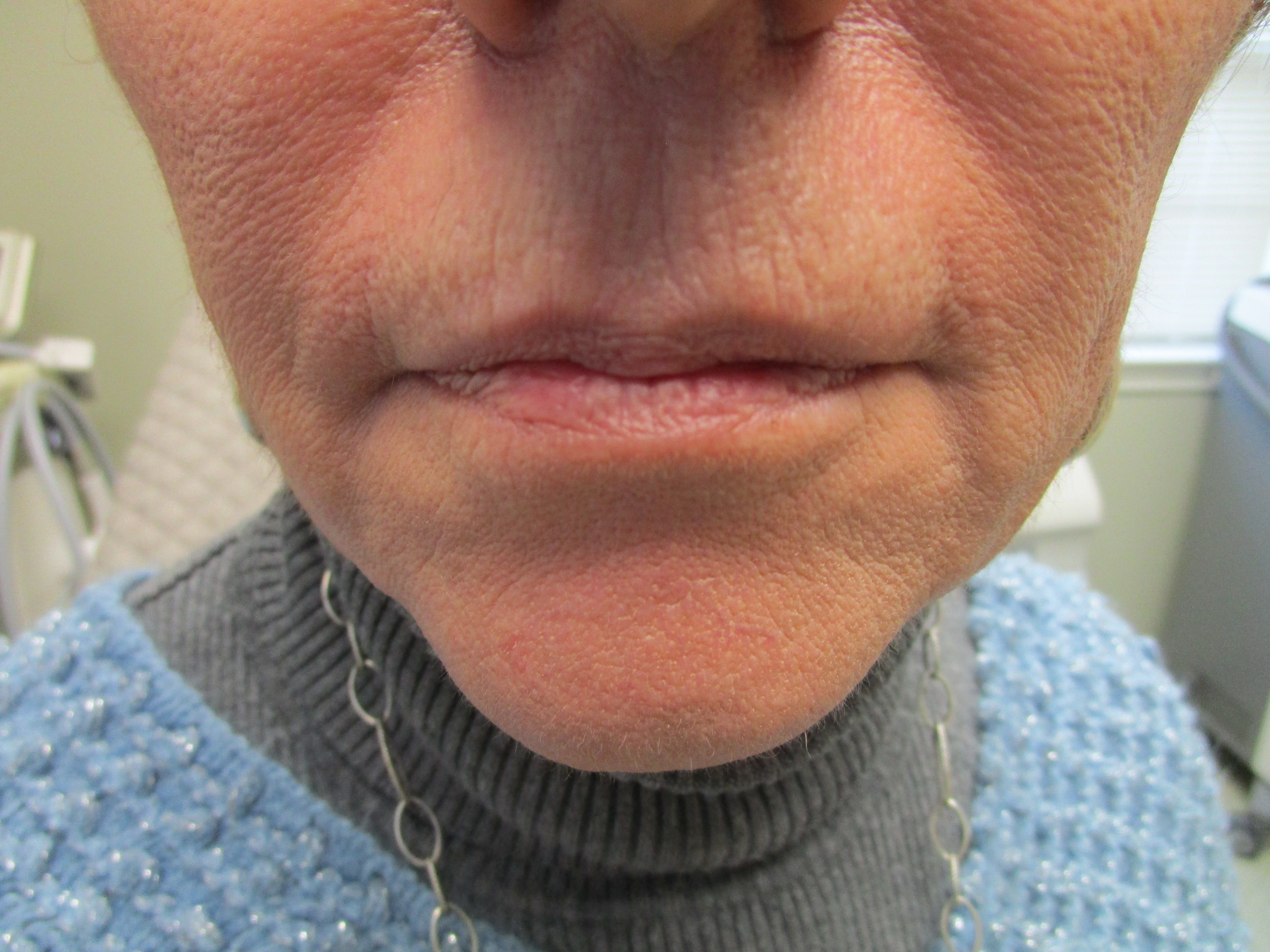 beforelipssmokerslines